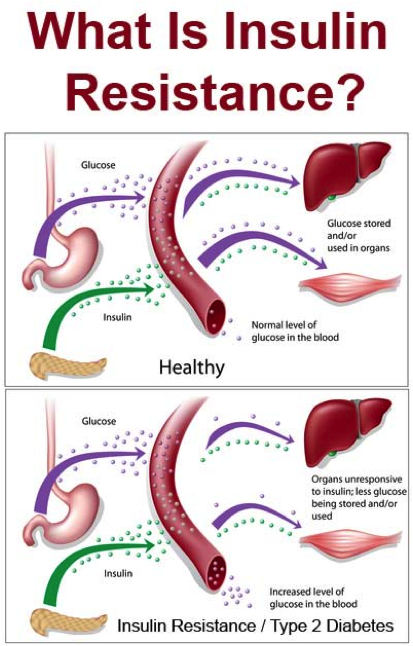 Insulin resistance